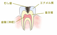 C2 【象牙質の虫歯】