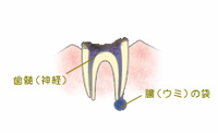 C4 【歯根まで達した虫歯】