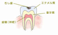C1 【エナメル質の虫歯】