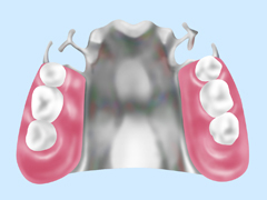 金属床義歯（部分入れ歯・総入れ歯）